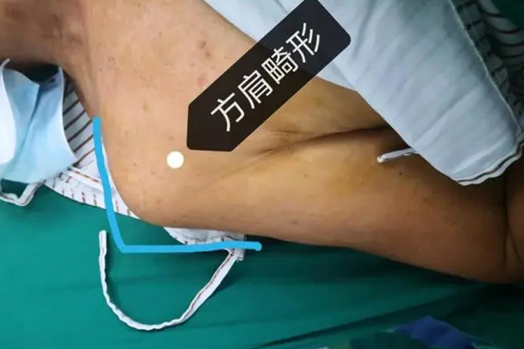 肩关节脱位方肩畸形图