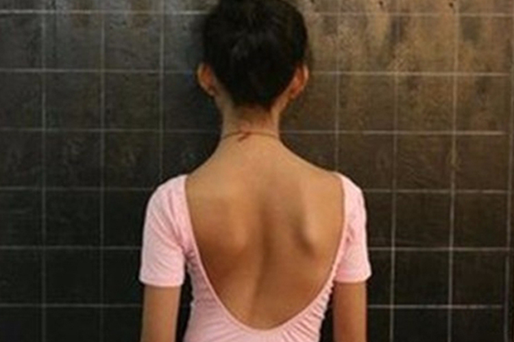 女孩左右肩胛骨不对等图