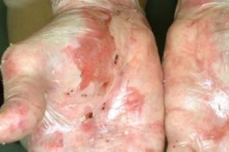 大疱性表皮松解症手掌红斑图 大疱性表皮松解症手掌红斑图