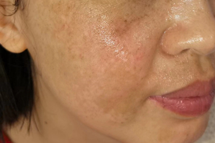 黄褐斑面部有斑块图 黄褐斑面部有斑块图