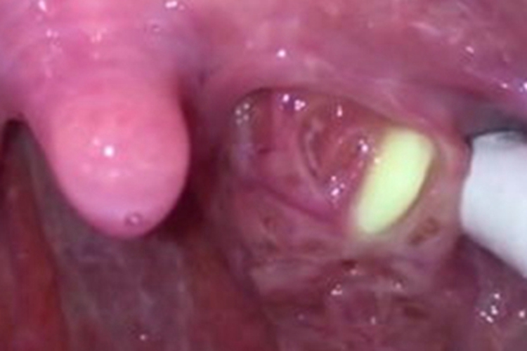 扁桃体结石黄白色硬块图 扁桃体结石黄白色硬块图