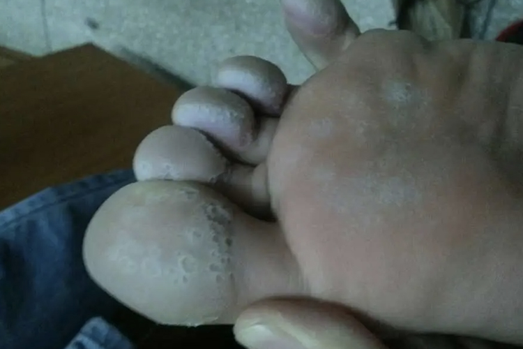 脚底水疱型足癣图