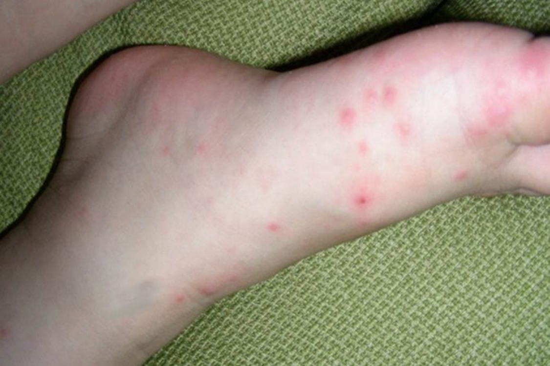 手足口病脚部疹子图