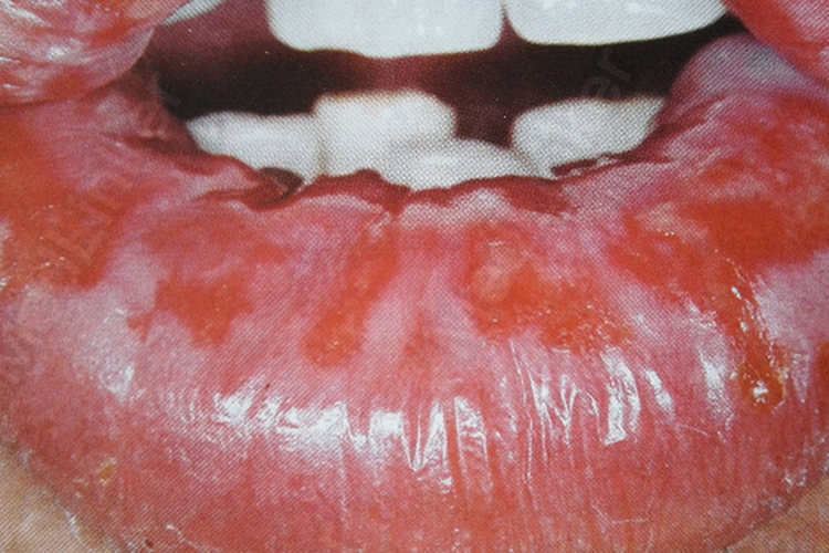 女性口腔霉菌感染症状图片