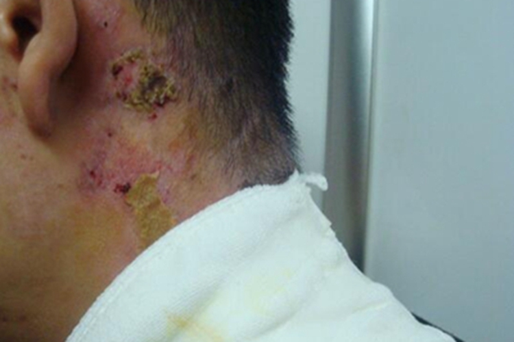 浅Ⅱ度烧伤耳后症状图