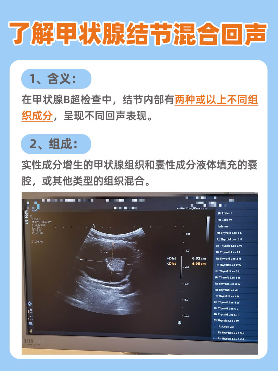 一文解析：甲状腺结节混合回声是什么意思？
