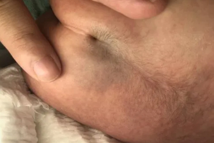 腰部皮肤异常改变图