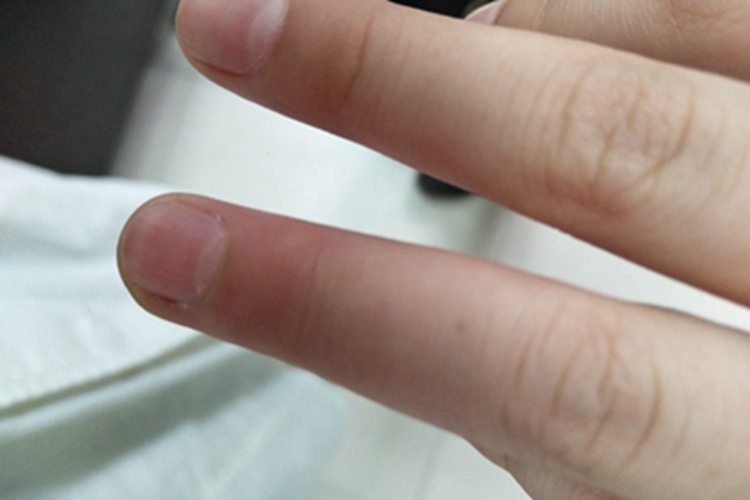 挫伤手指发红肿胀图