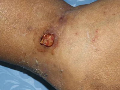 龟分枝杆菌皮肤感染症状图片