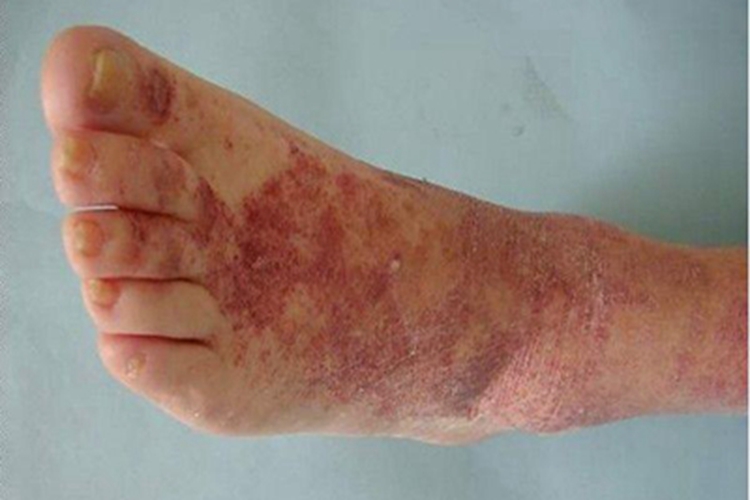 金黄色苔藓症状图