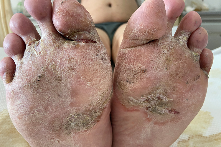 脚部亚急性湿疹图