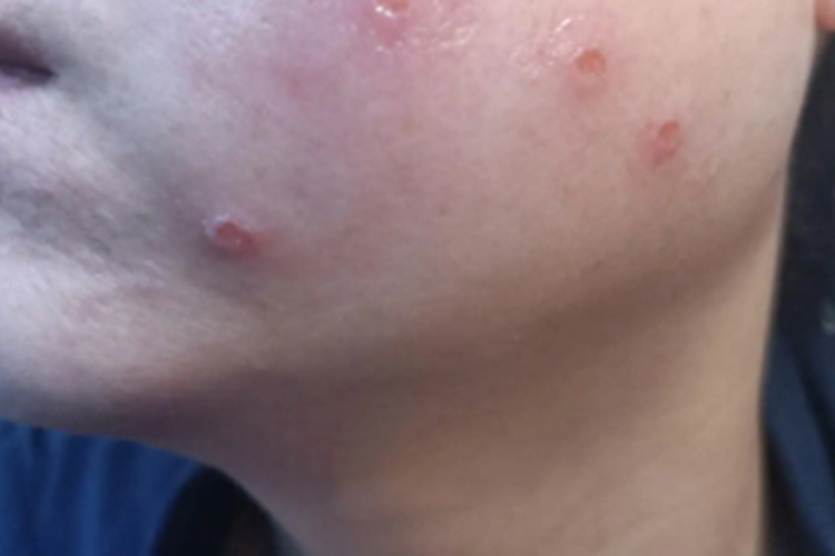 牛痘样水疱病典型轻型面部渗液图