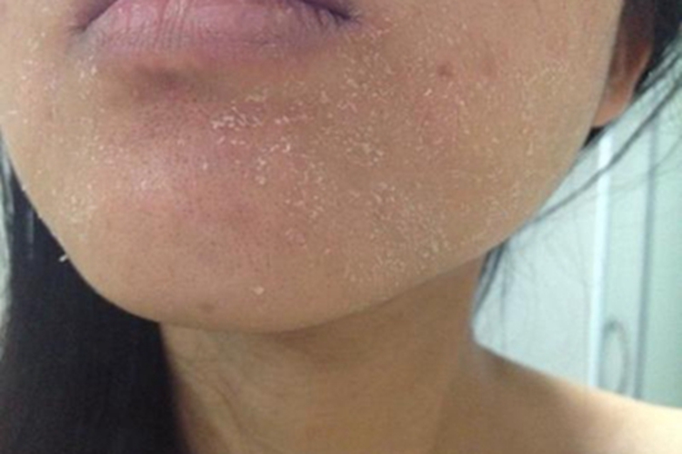 维生素A过多症面部脱屑图 维生素A过多症面部脱屑图