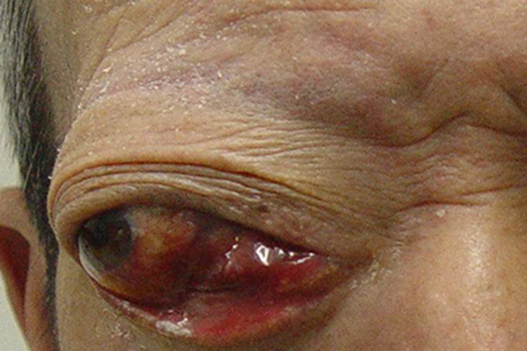 眼眶海绵状血管瘤眼球突出严重图