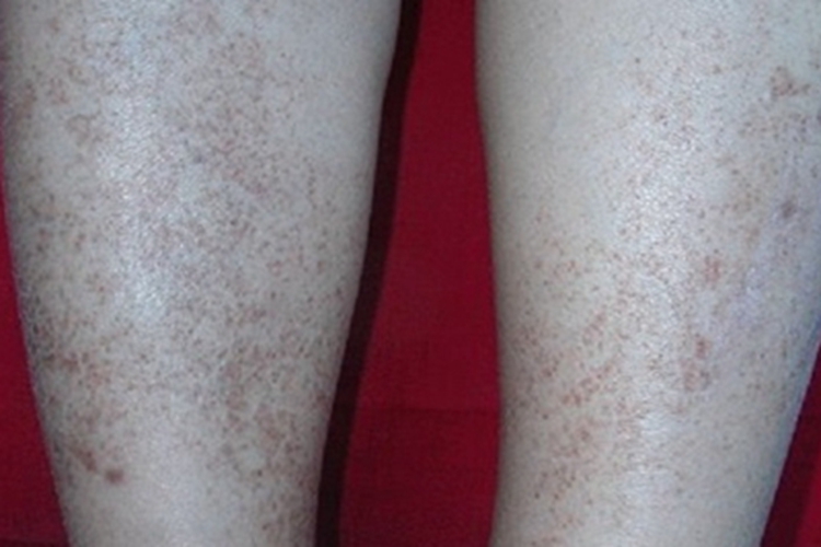 高球蛋白血症性紫癜小腿症状图 高球蛋白血症性紫癜小腿症状图