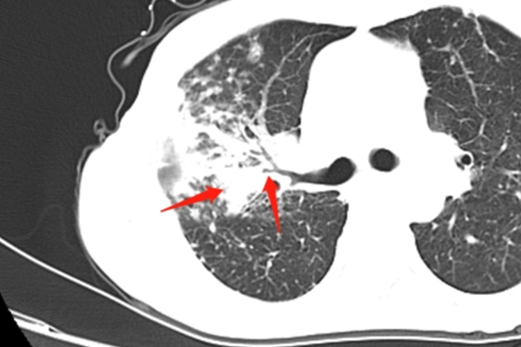 原发性肺结核CT图 原发性肺结核CT图