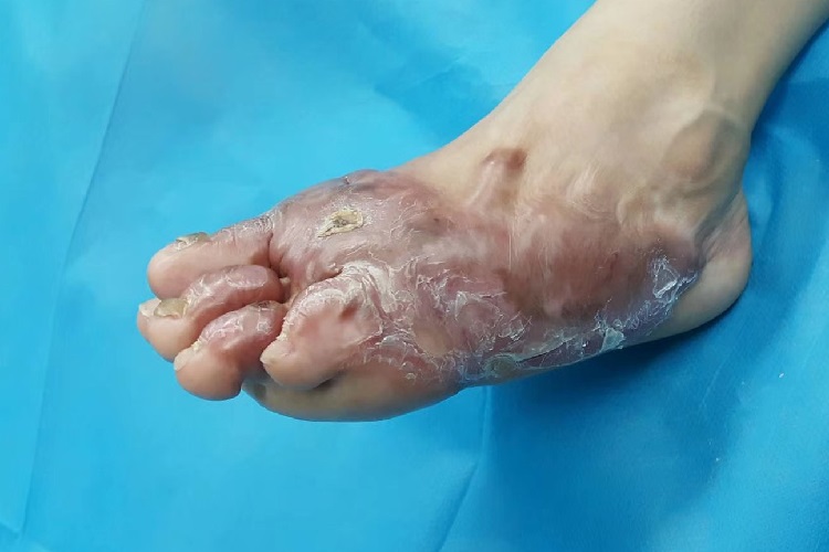 皮肤再生不良脚部瘢痕图