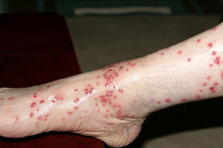 恙螨皮炎脚背小红疙瘩图