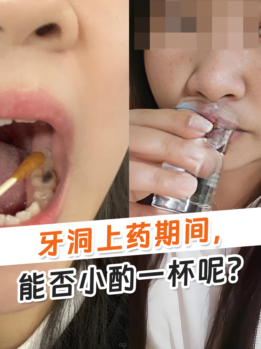 牙洞上药期间，能否小酌一杯呢？