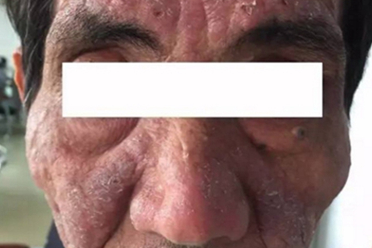 慢性光线性皮炎面部皮肤增厚图