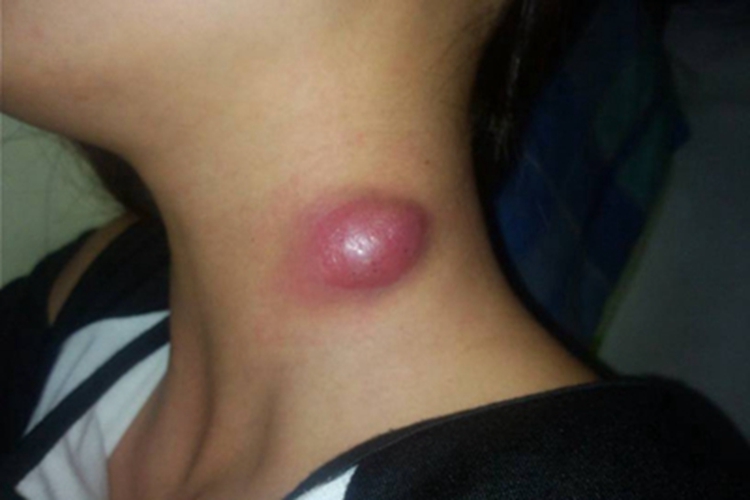 面颈部放线菌病包块图