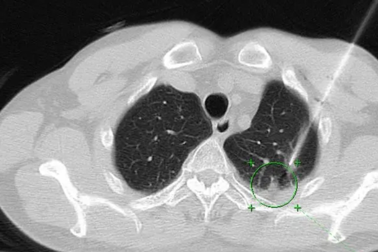 继发性肺肿瘤CT图