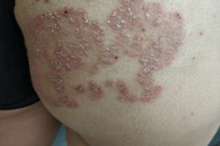 股癣臀部外侧隆起红斑图