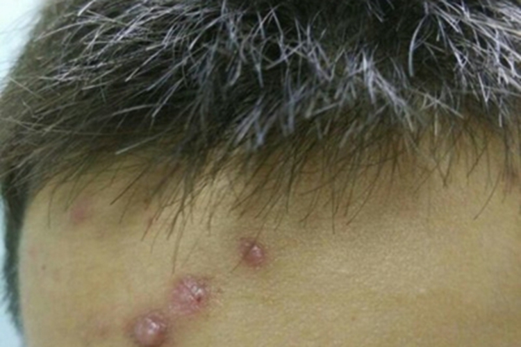 隐球菌病前额症状图