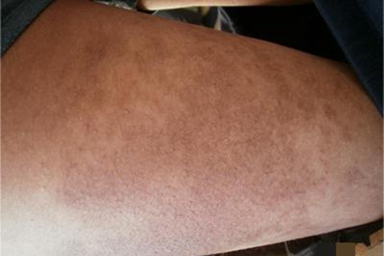 炎症型表皮痣大腿症状图