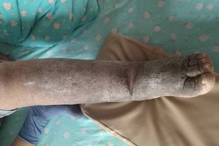 丝虫病慢性期皮肤发黑图