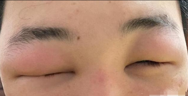 木村病双侧眼睑肿胀眼睛睁不开图.png