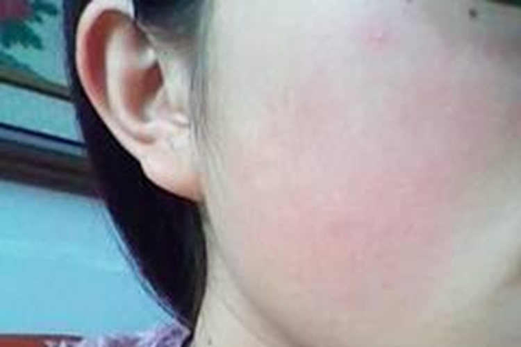 肾阴虚颧骨泛红图