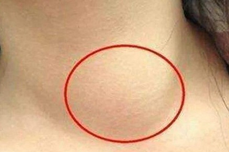 甲状腺腺瘤硬包图