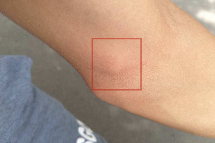 手肘腱鞘囊肿图