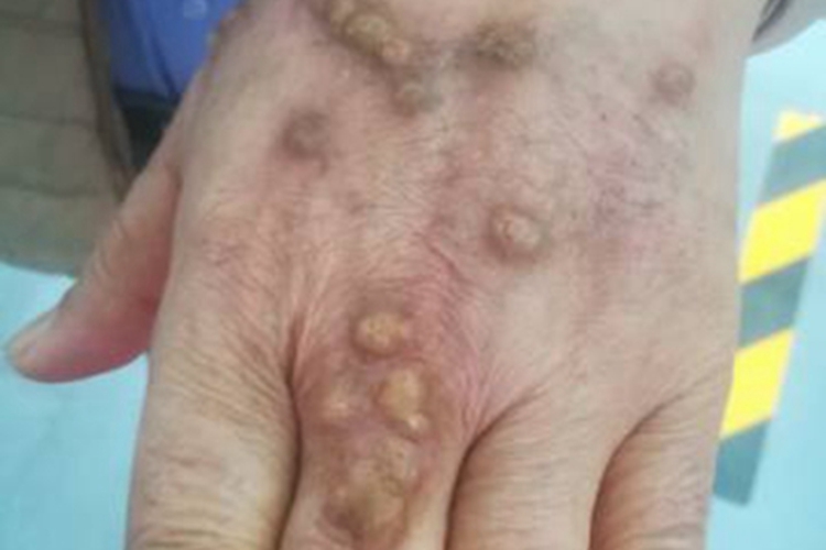 痒疹手背疙瘩图