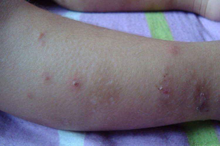 小儿痒疹小腿有丘疹表面结痂图 小儿痒疹小腿有丘疹表面结痂图