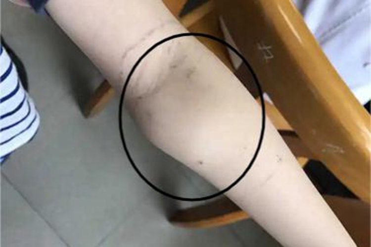 滑膜肉瘤胳膊大包图 滑膜肉瘤胳膊大包图