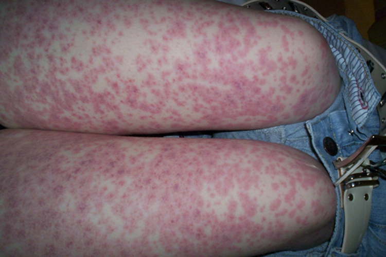 过敏性紫癜大腿疙瘩图