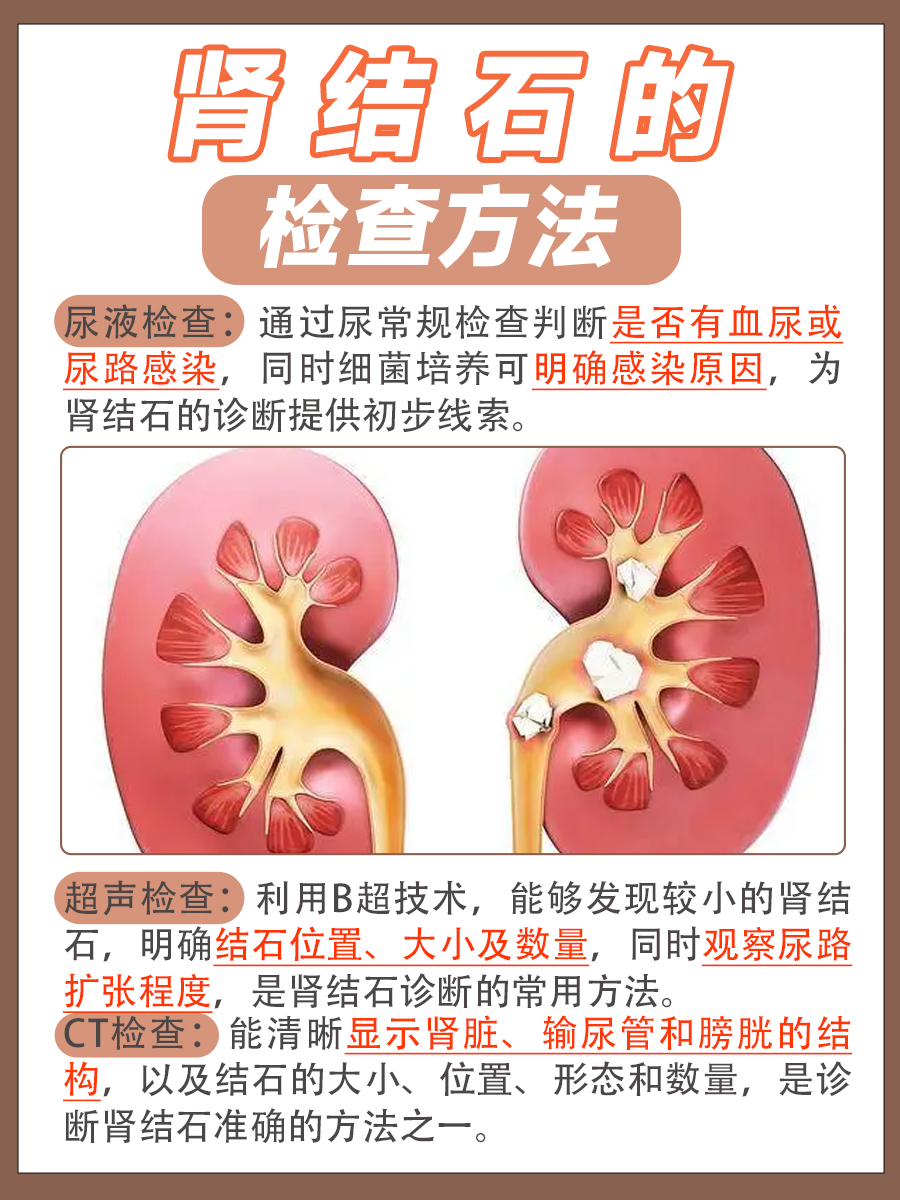 肾结石的症状表现你了解吗？速来围观
