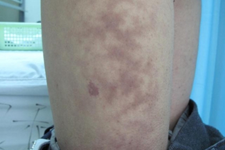 特发性网状青斑症状图