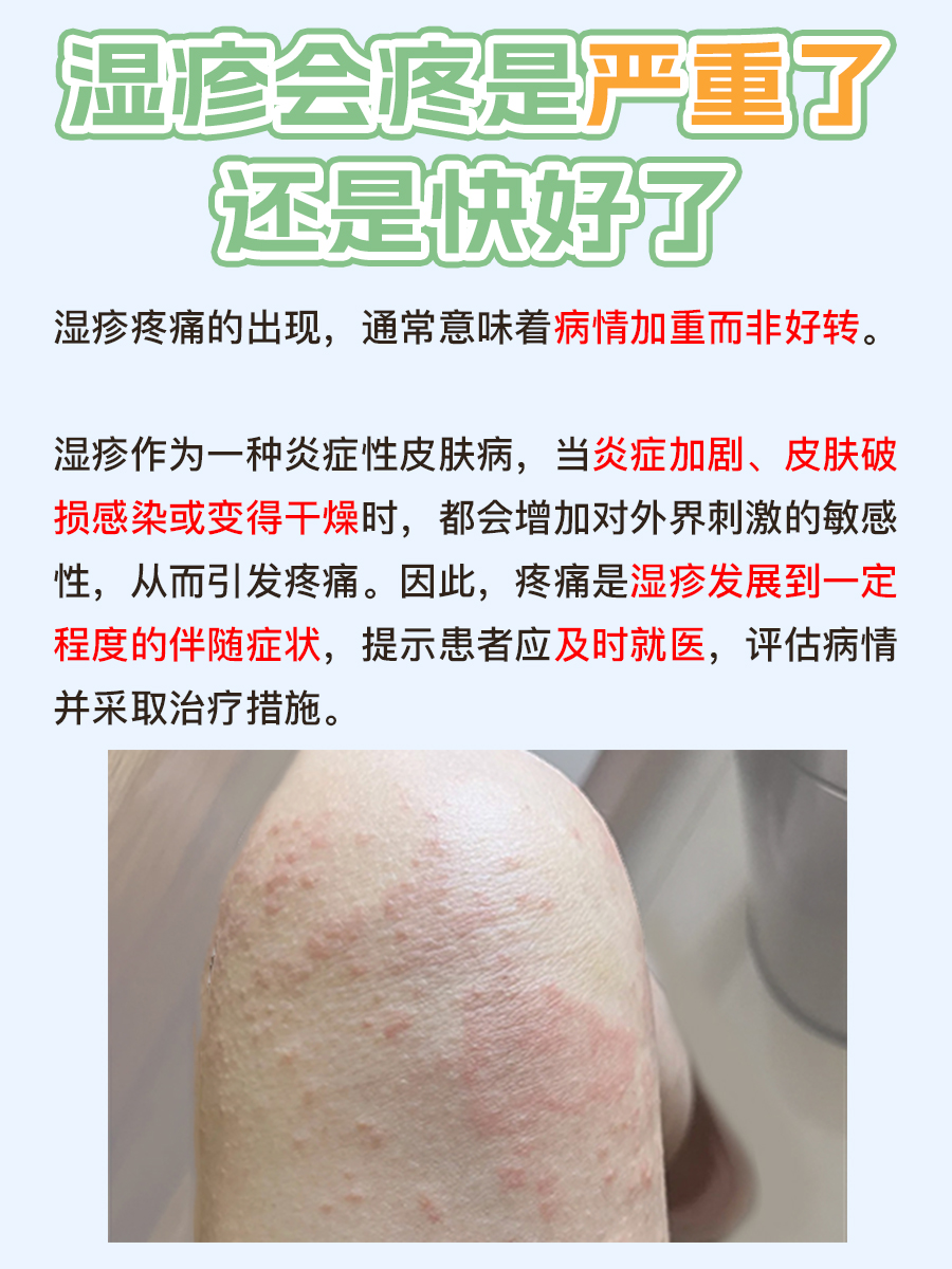 湿疹疼痛，是好转前的黎明还是恶化信号？