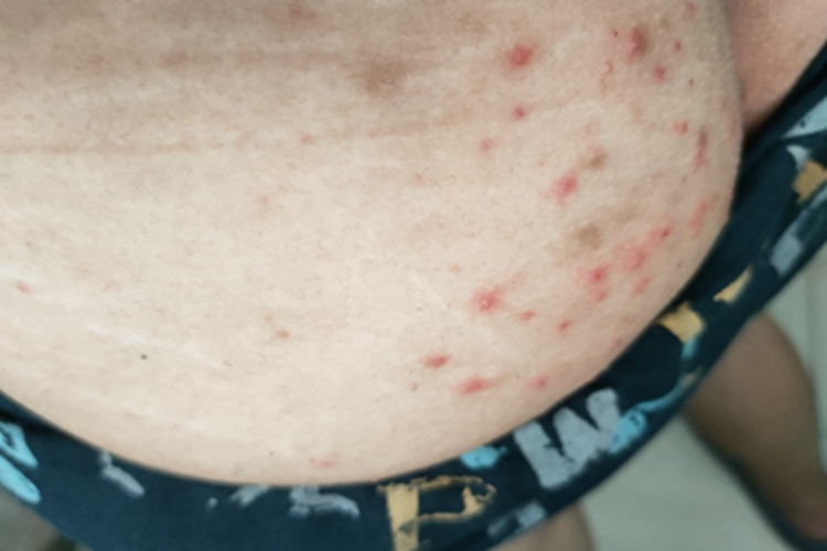 毛囊炎腹部丘疹图 毛囊炎腹部丘疹图