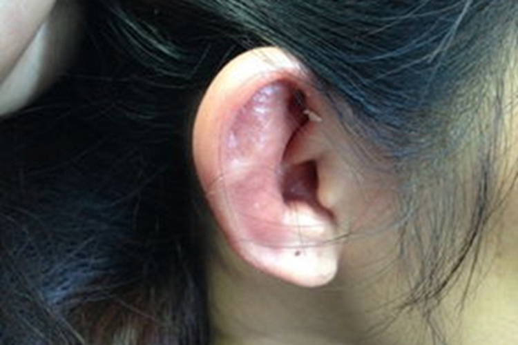 耳廓挫伤耳朵又红又肿图