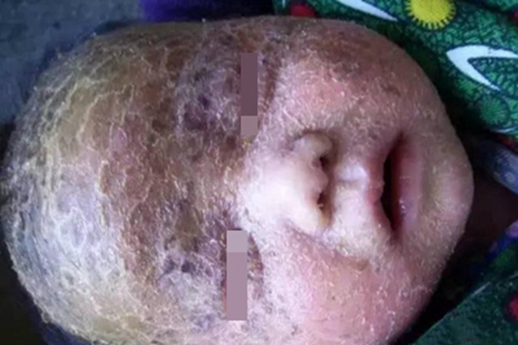 火棉胶婴儿脱屑图