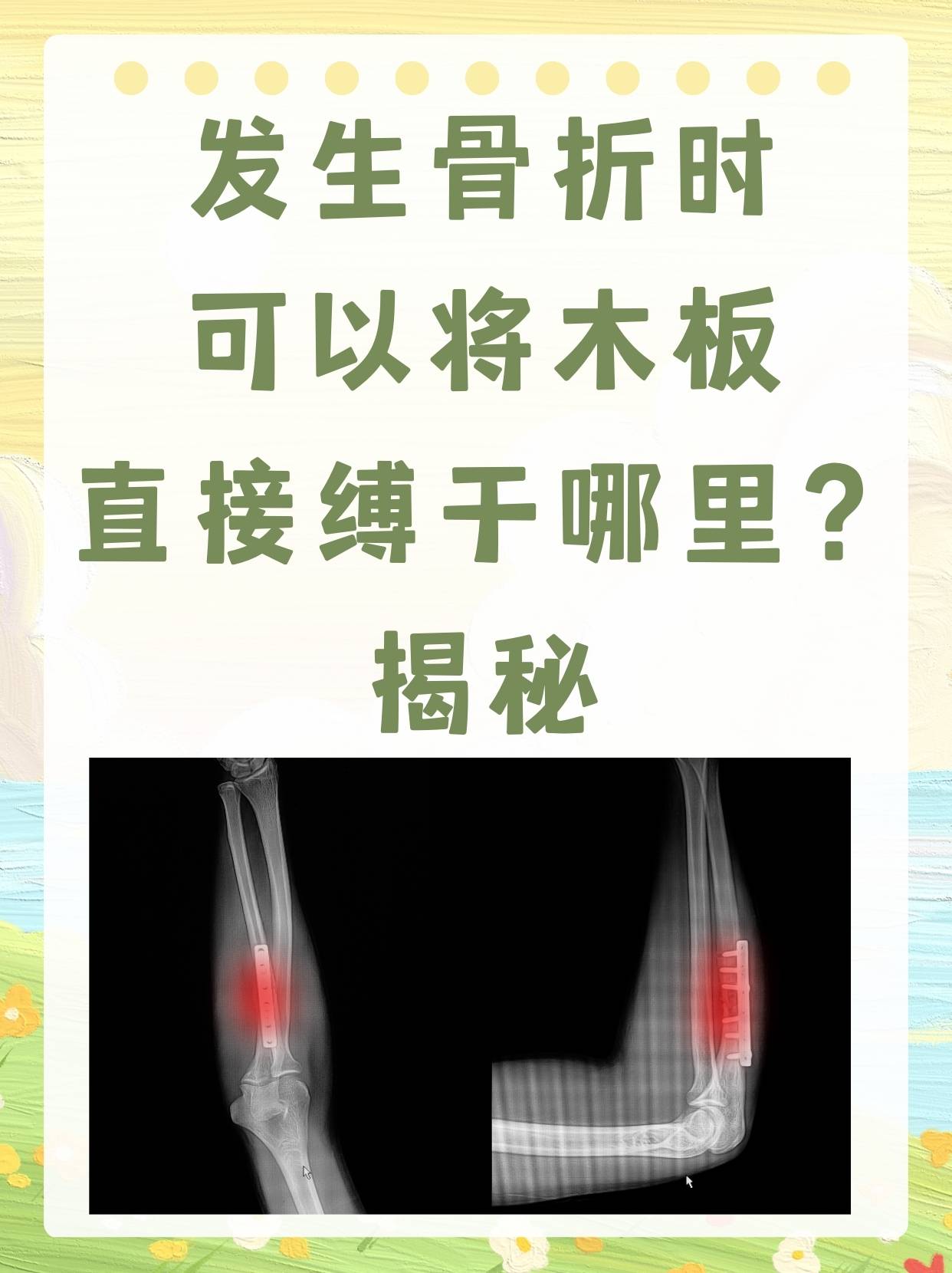 发生骨折时可以将木板直接缚于哪里？揭秘