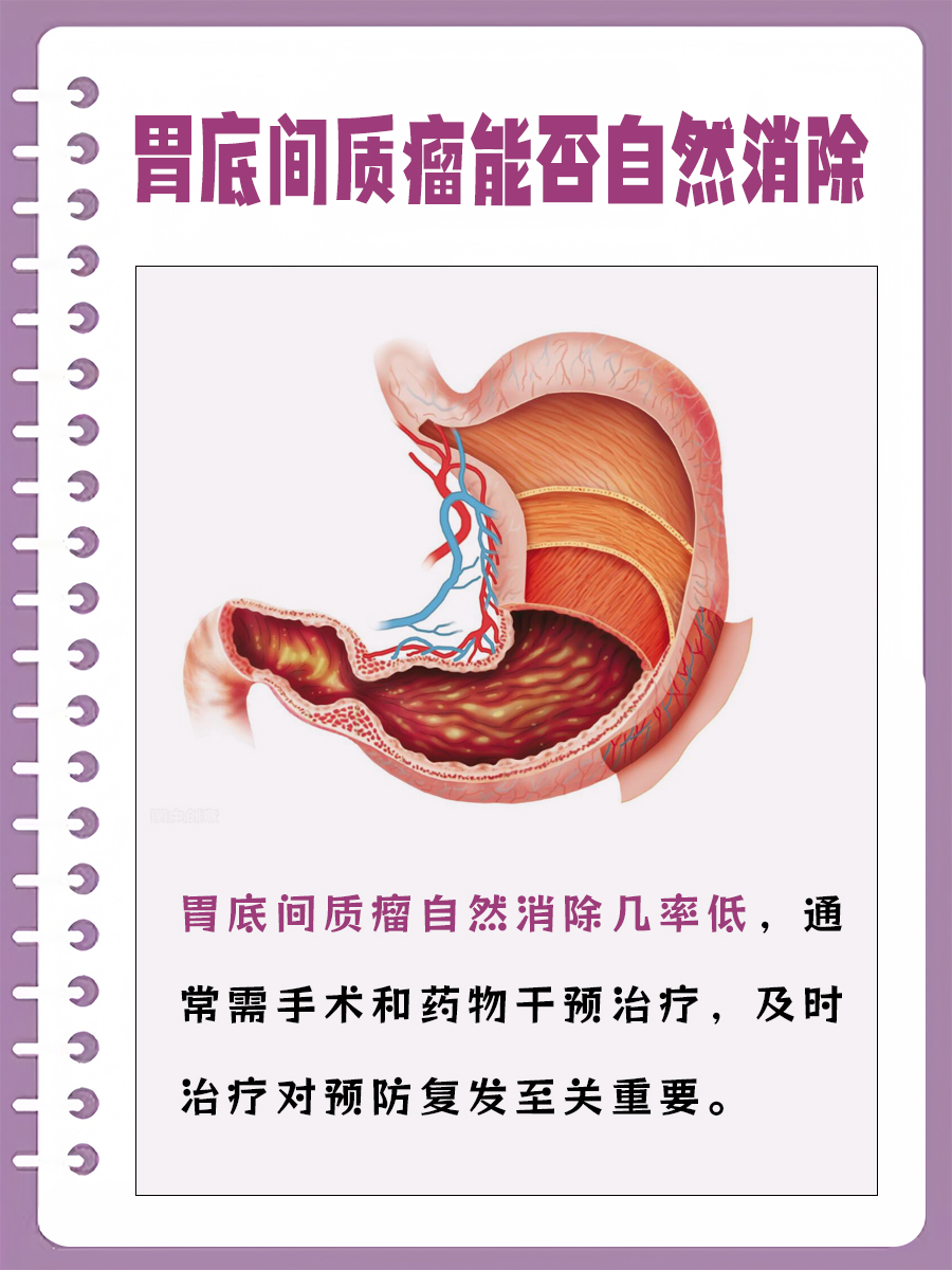 胃底间质瘤：能否自然消除？