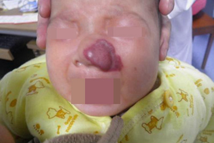 混合型婴儿血管瘤鼻尖红斑图 混合型婴儿血管瘤鼻尖红斑图