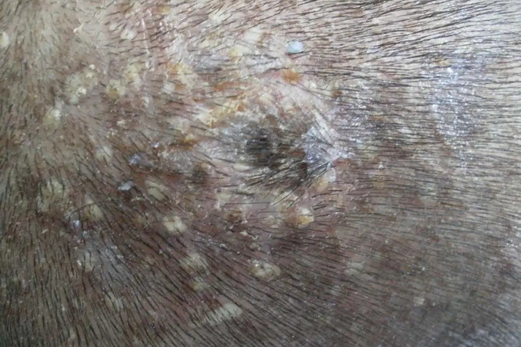 小儿黄癣初期皮损图