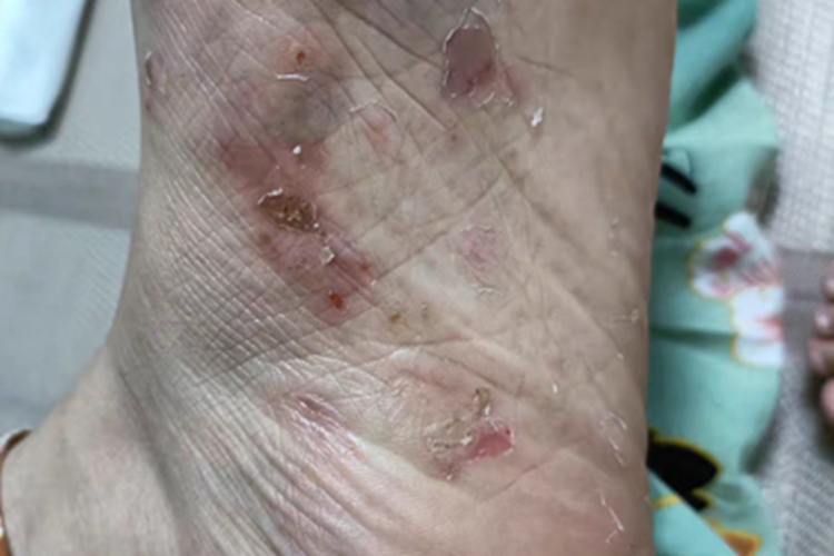 足癣脚底红斑图