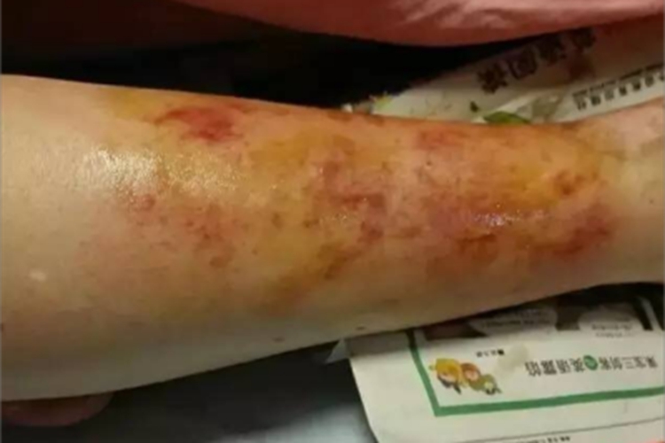 软组织感染小腿肿图